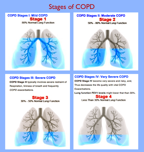 Mobility Devices for Chronic Obstructive Pulmonary Disease